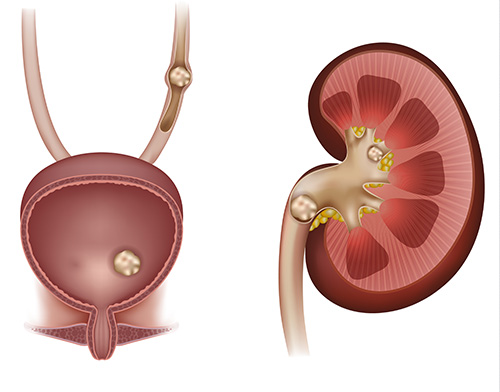 Shock Wave Lithotripsy (ESWL)